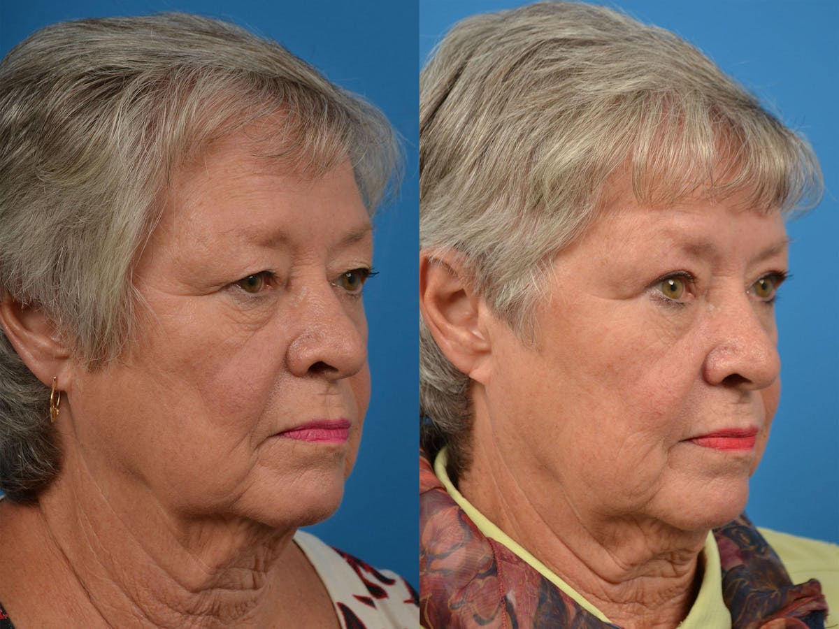 Brow Lift Before & After Gallery - Patient 122405601 - Image 2