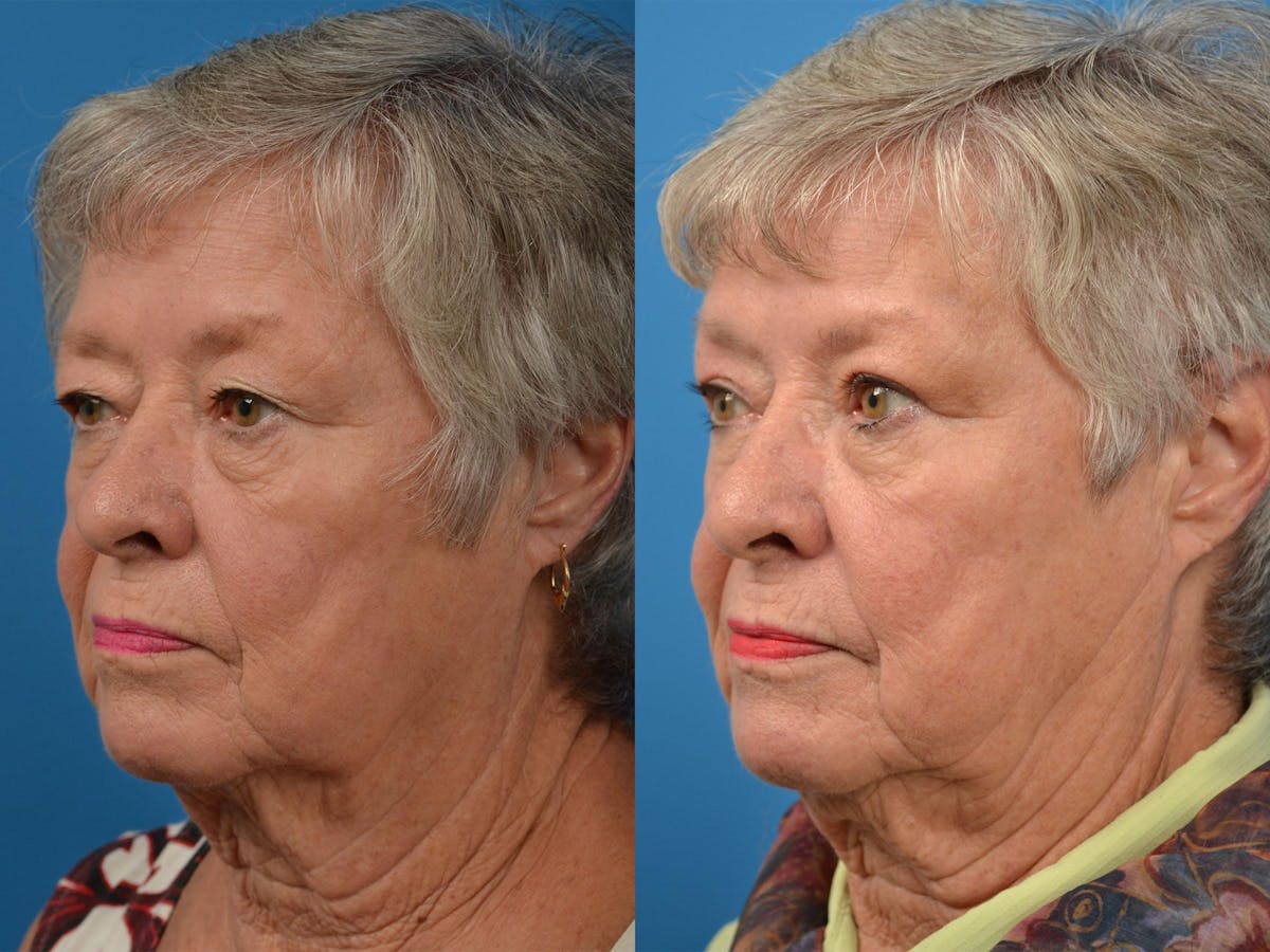 Brow Lift Before & After Gallery - Patient 122405601 - Image 3