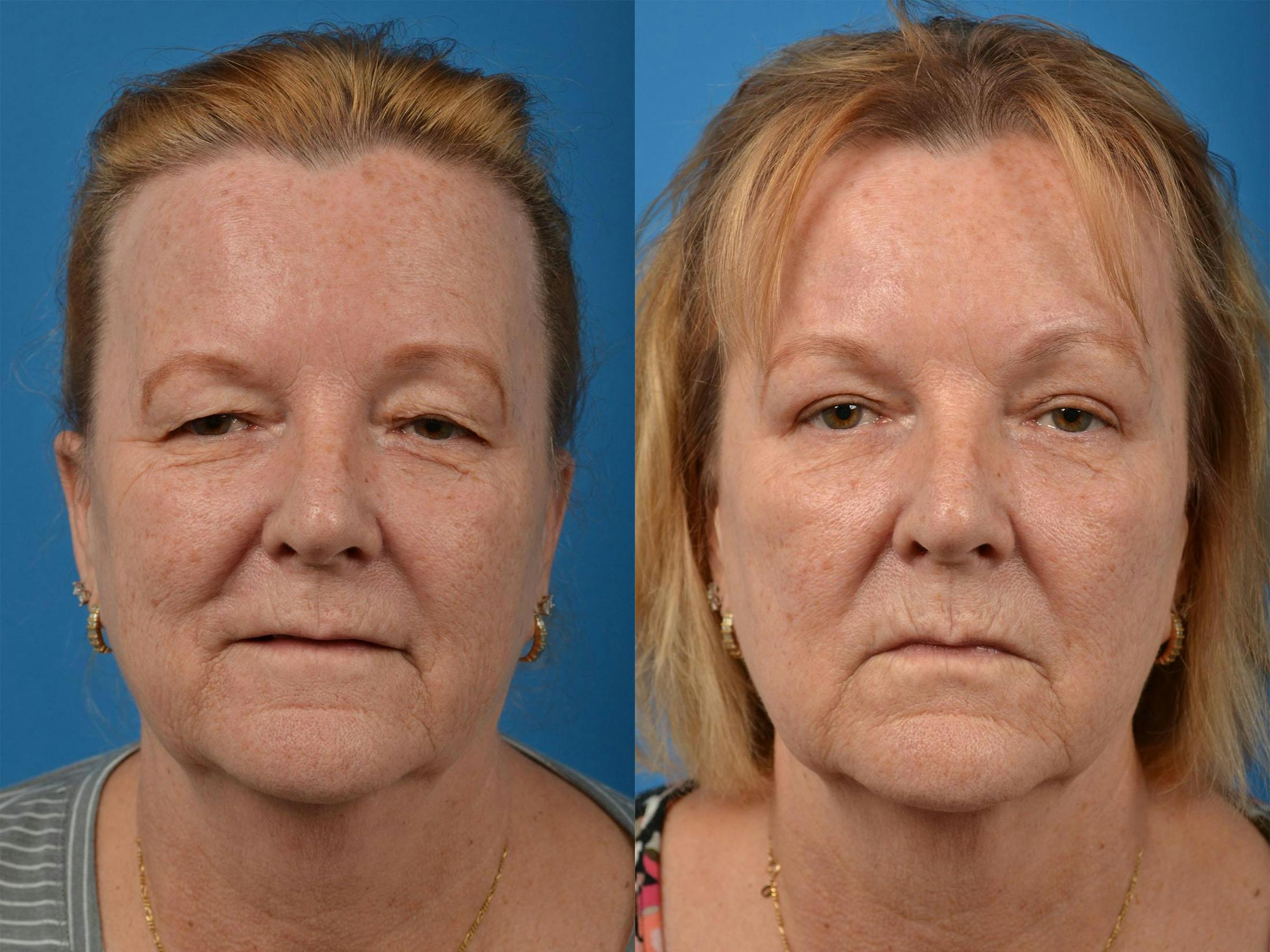 Brow Lift Before & After Gallery - Patient 122405605 - Image 1