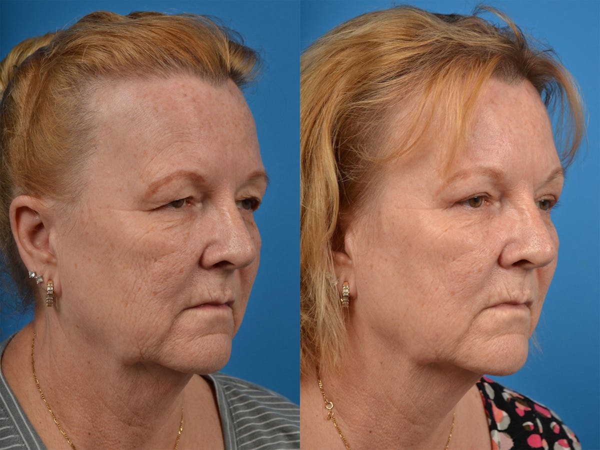 Brow Lift Before & After Gallery - Patient 122405605 - Image 2
