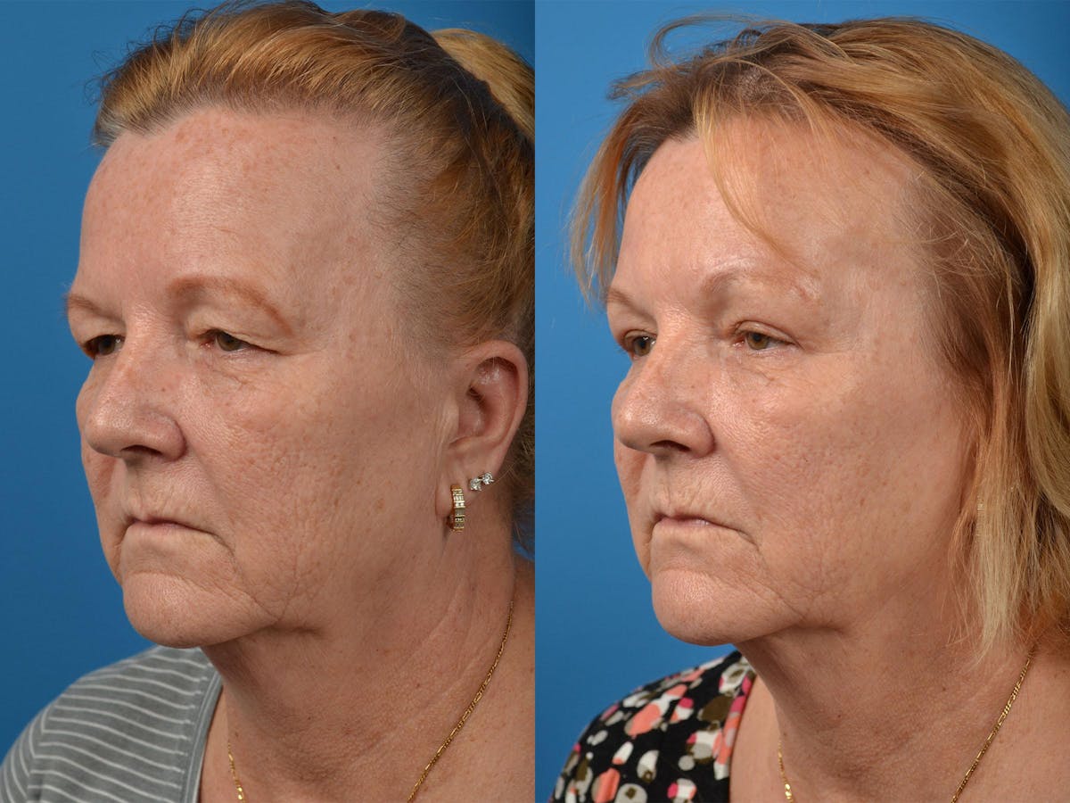 Brow Lift Before & After Gallery - Patient 122405605 - Image 4