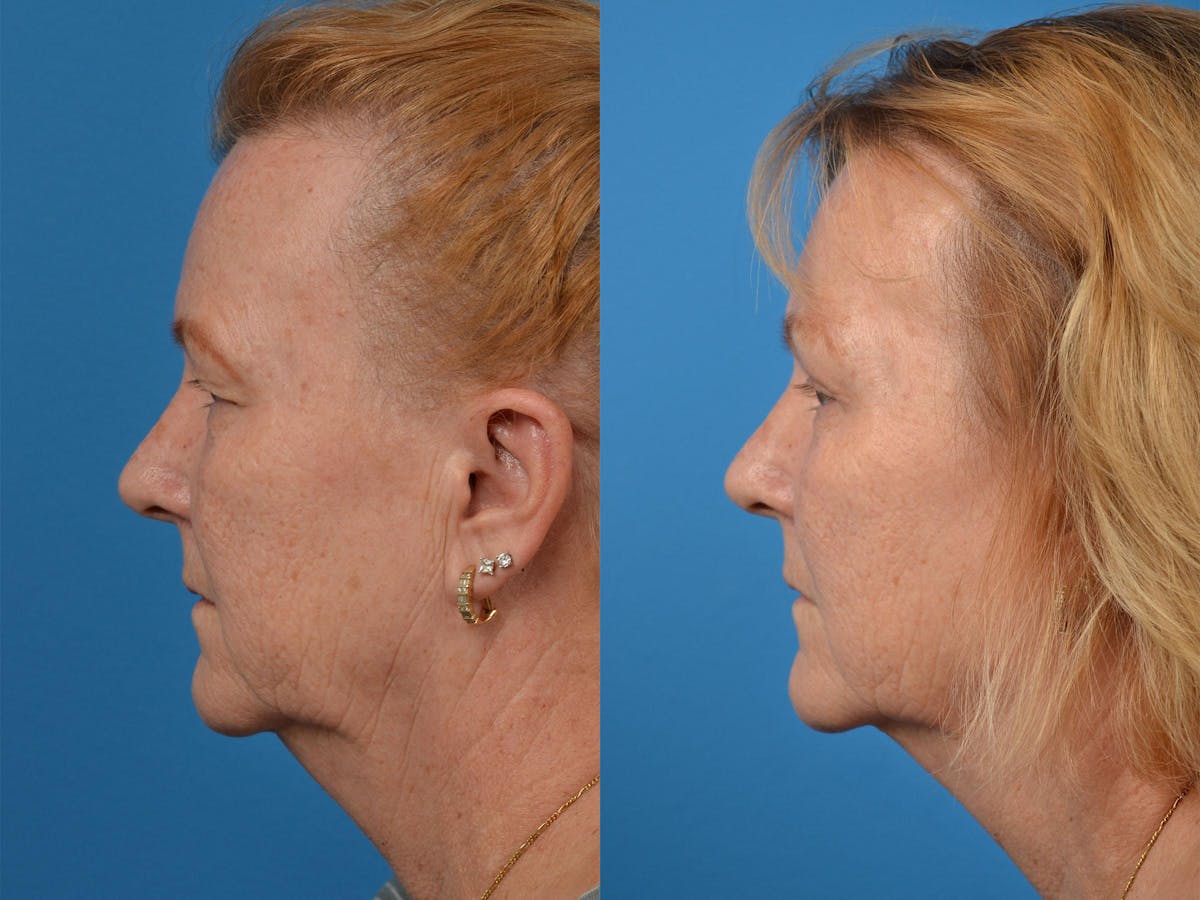 Brow Lift Before & After Gallery - Patient 122405605 - Image 5