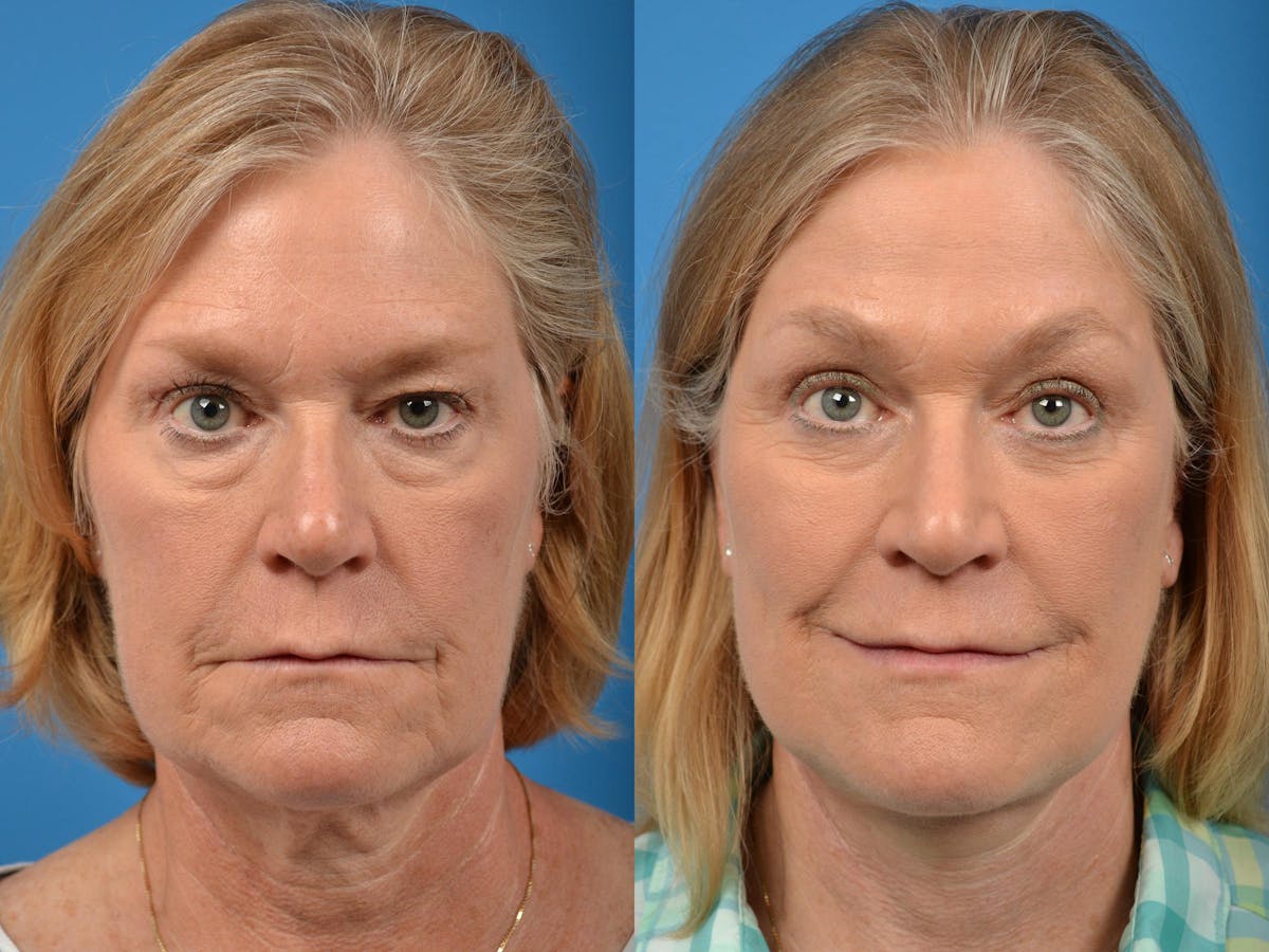 Brow Lift Before & After Gallery - Patient 122405607 - Image 1