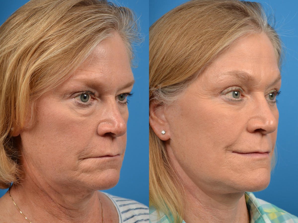 Brow Lift Before & After Gallery - Patient 122405607 - Image 2
