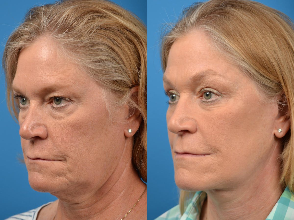 Brow Lift Before & After Gallery - Patient 122405607 - Image 4