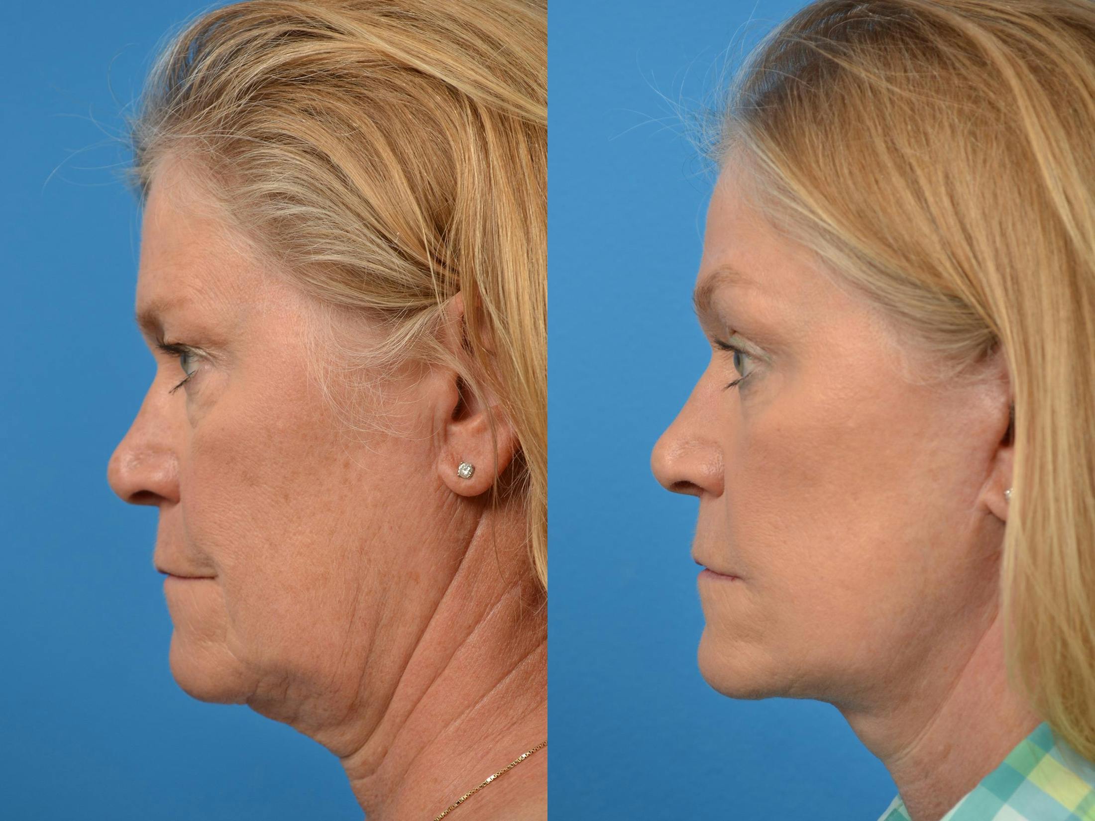 Brow Lift Before & After Gallery - Patient 122405607 - Image 5