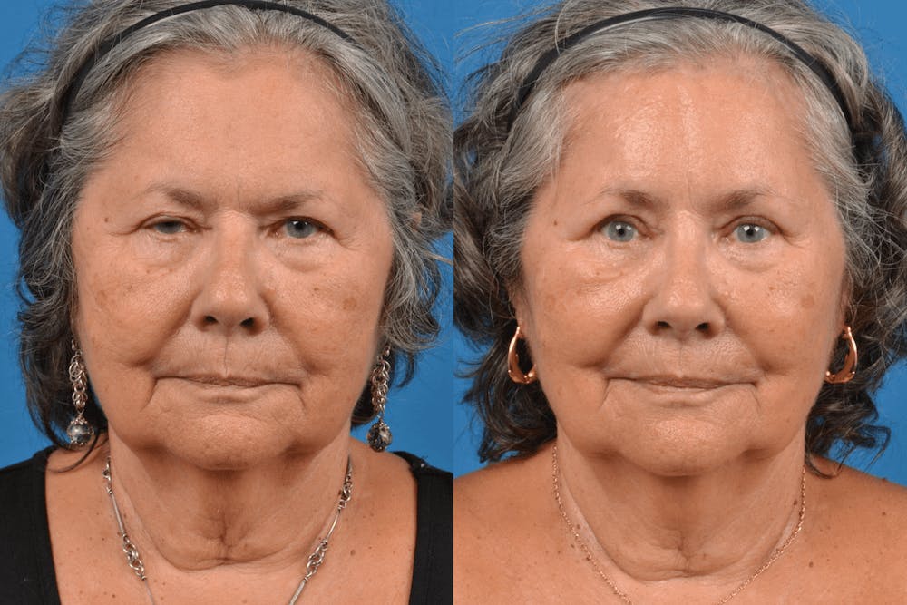 Brow Lift Before & After Gallery - Patient 122405611 - Image 1