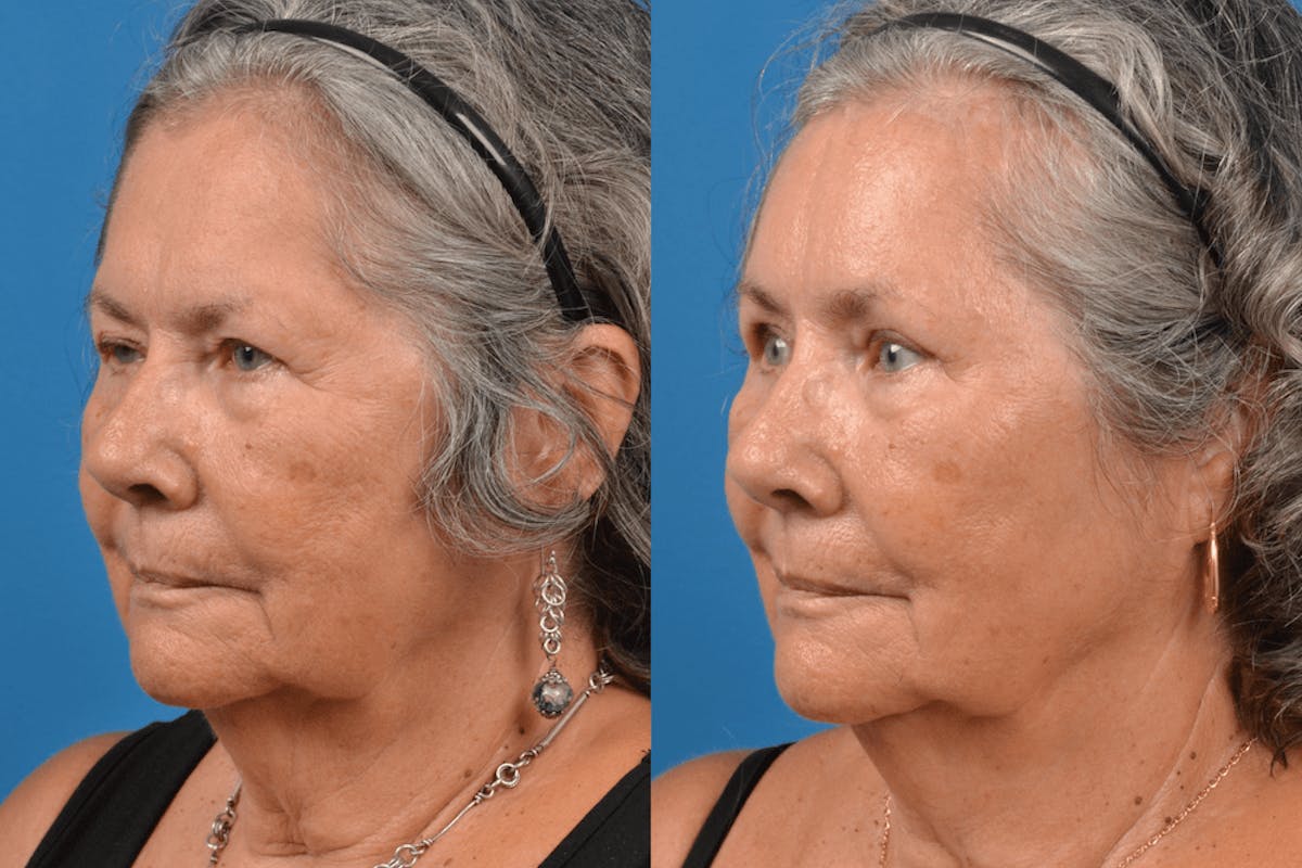 Brow Lift Before & After Gallery - Patient 122405611 - Image 2