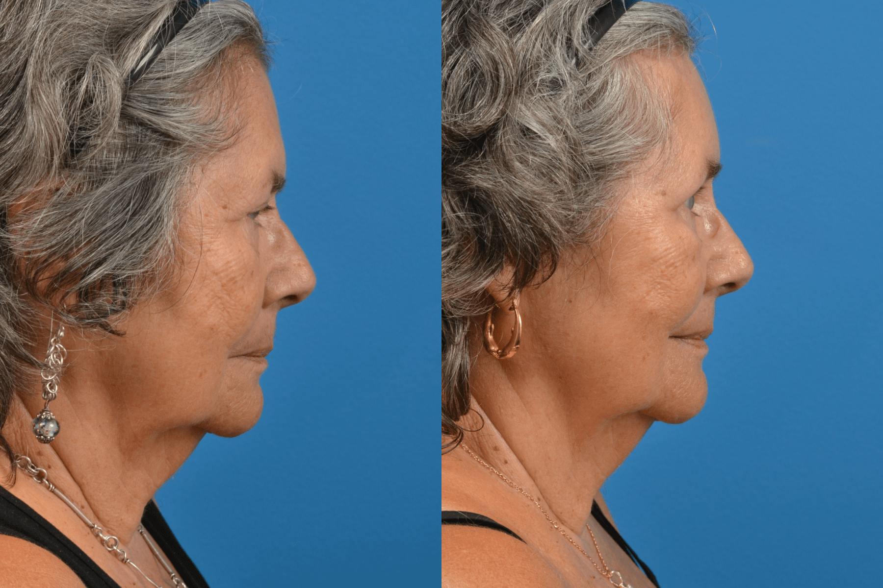 Brow Lift Before & After Gallery - Patient 122405611 - Image 3