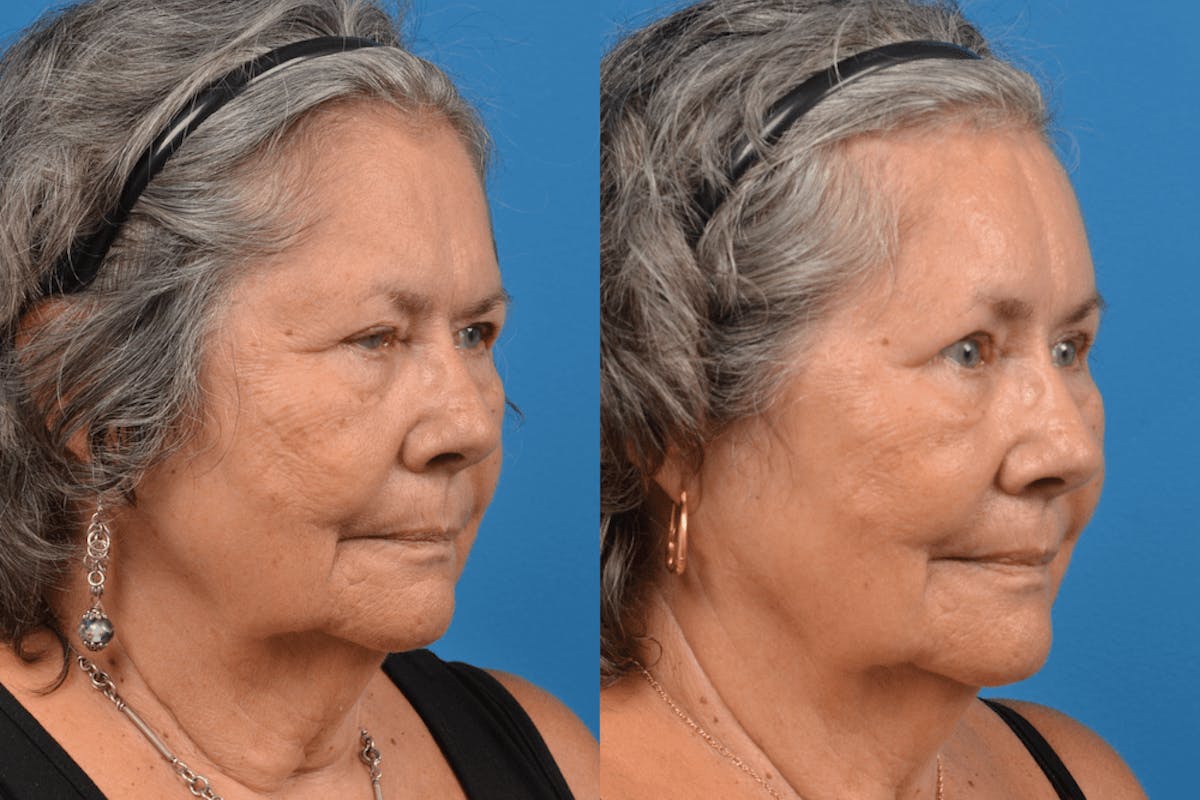 Brow Lift Before & After Gallery - Patient 122405611 - Image 4