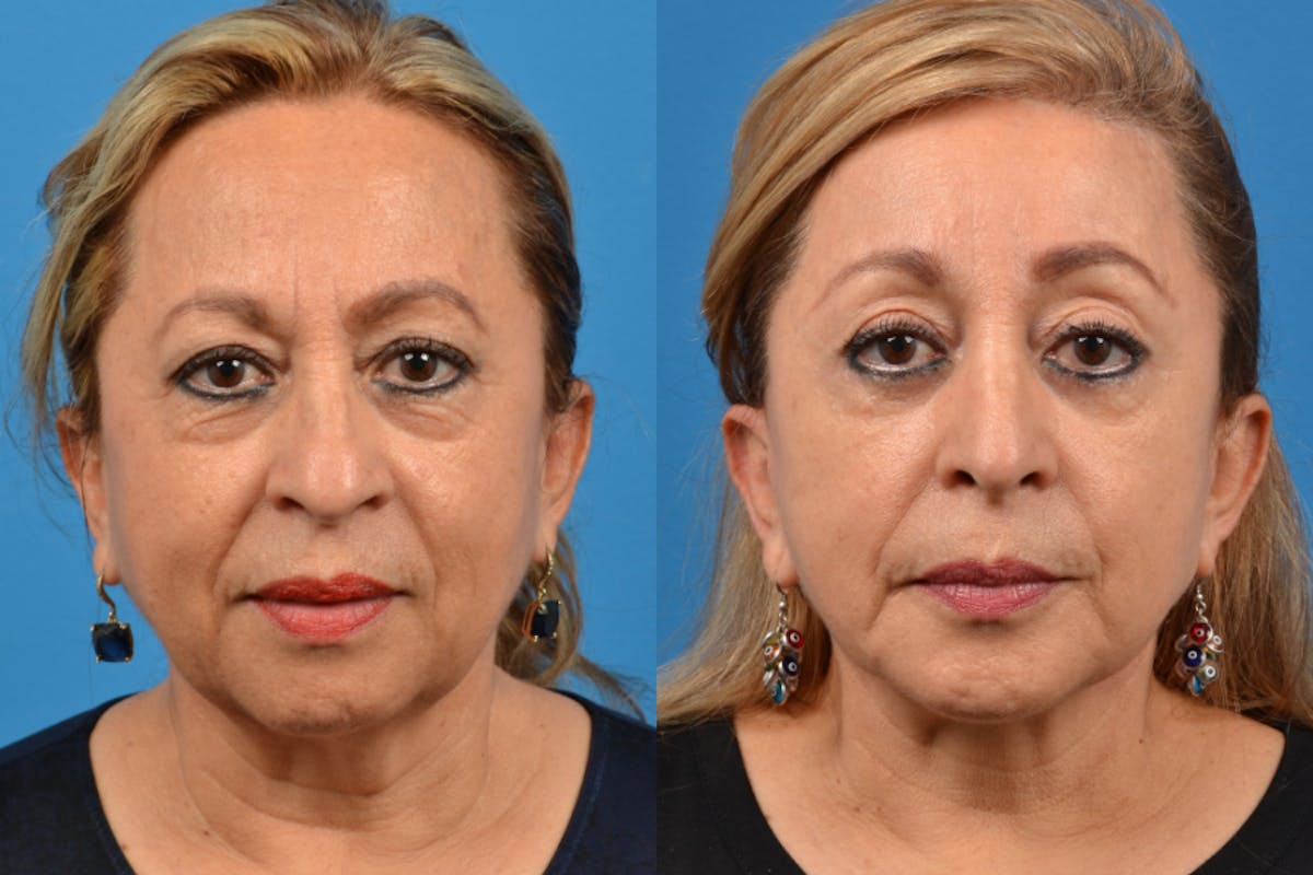 Brow Lift Before & After Gallery - Patient 122405614 - Image 1