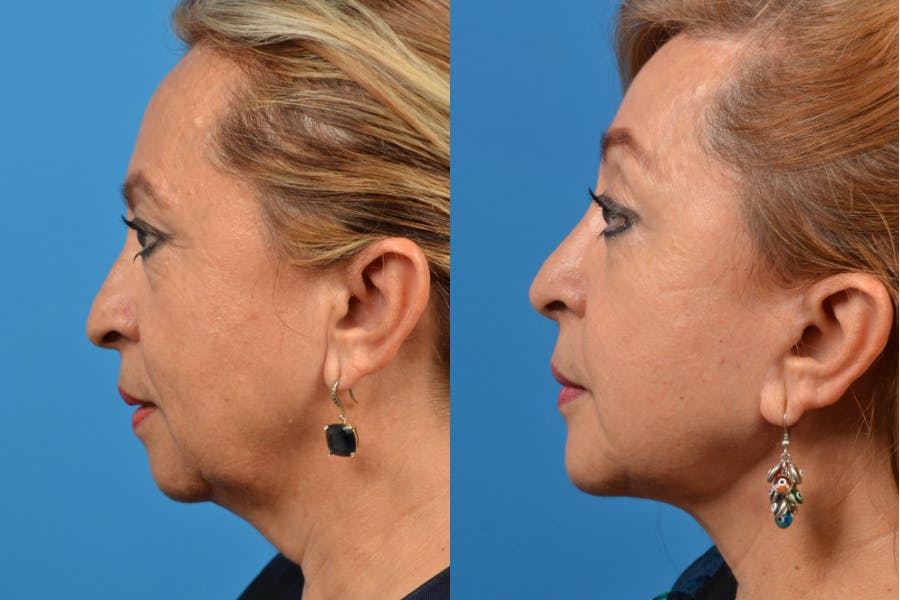 Brow Lift Before & After Gallery - Patient 122405614 - Image 2