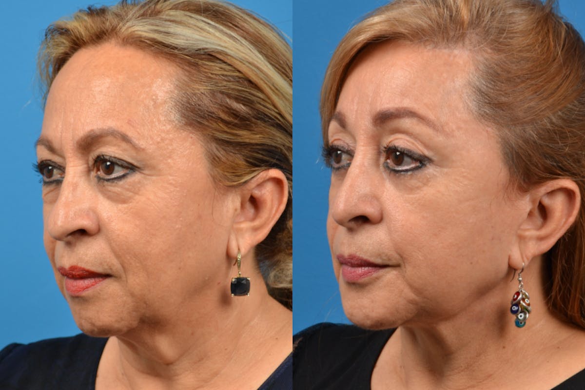 Brow Lift Before & After Gallery - Patient 122405614 - Image 3