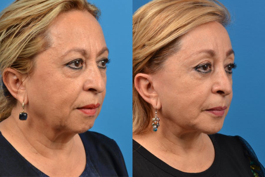 Brow Lift Before & After Gallery - Patient 122405614 - Image 4