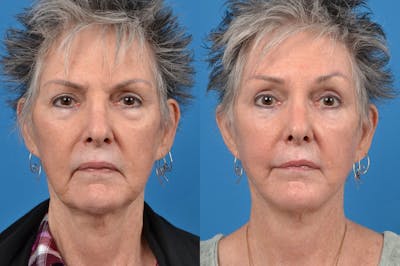 Brow Lift Before & After Gallery - Patient 122405615 - Image 1