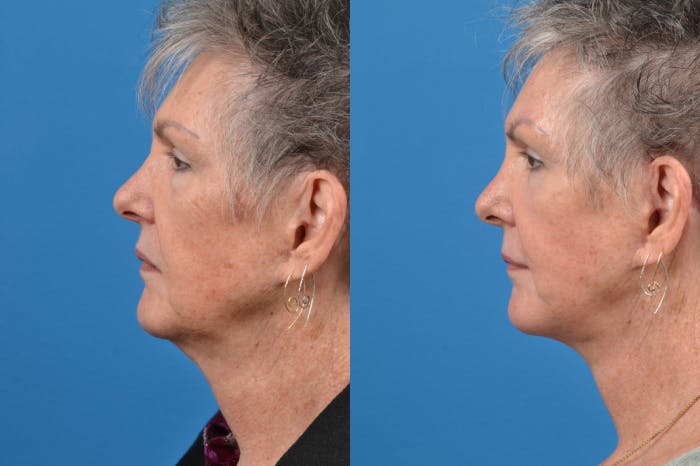 Brow Lift Before & After Gallery - Patient 122405615 - Image 2