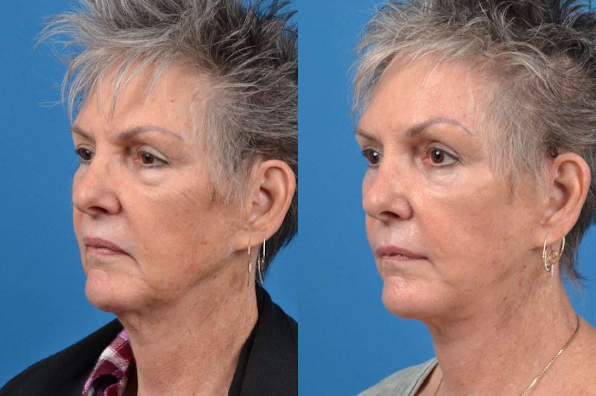 Brow Lift Before & After Gallery - Patient 122405615 - Image 3