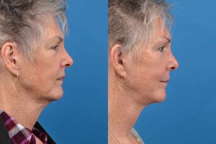 Brow Lift Before & After Gallery - Patient 122405615 - Image 4