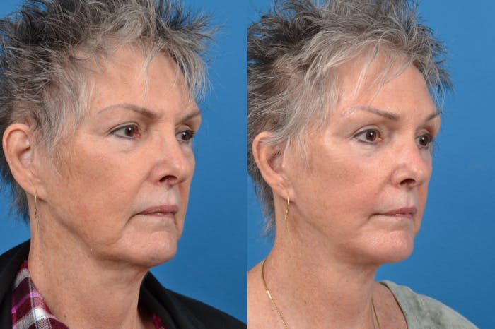 Brow Lift Before & After Gallery - Patient 122405615 - Image 5