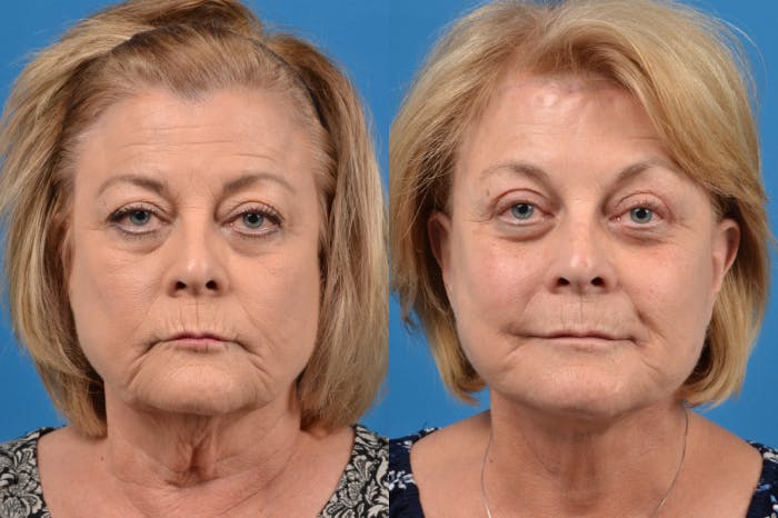 Brow Lift Before & After Gallery - Patient 122405616 - Image 1