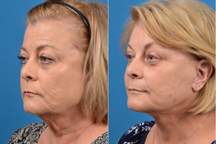 Brow Lift Before & After Gallery - Patient 122405616 - Image 2