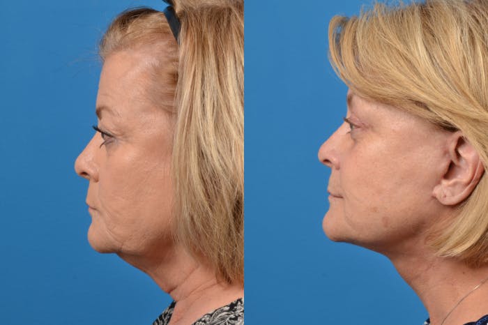 Brow Lift Before & After Gallery - Patient 122405616 - Image 3