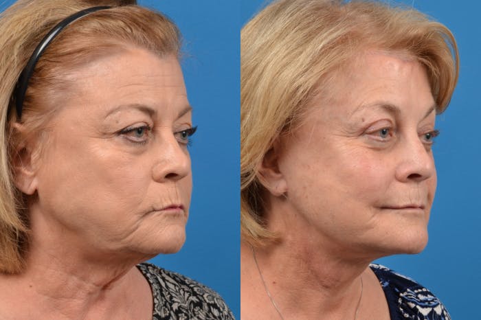 Brow Lift Before & After Gallery - Patient 122405616 - Image 4