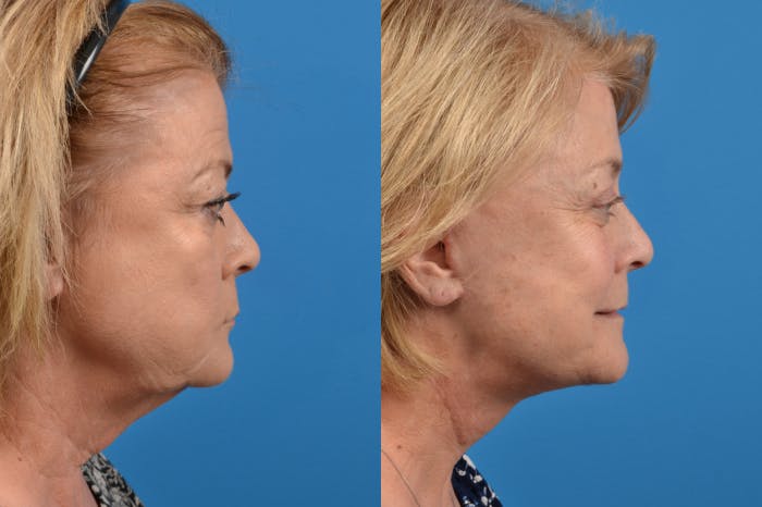 Brow Lift Before & After Gallery - Patient 122405616 - Image 5