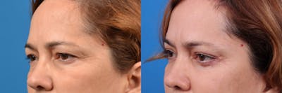 Brow Lift Before & After Gallery - Patient 122405617 - Image 1
