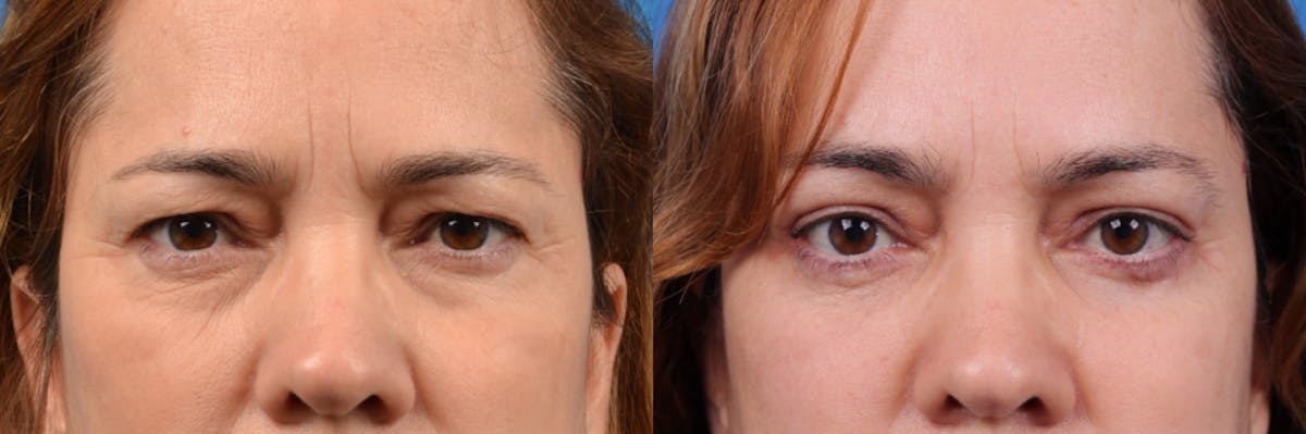 Brow Lift Before & After Gallery - Patient 122405617 - Image 2