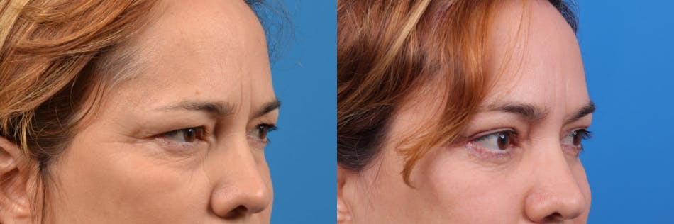 Brow Lift Before & After Gallery - Patient 122405617 - Image 3