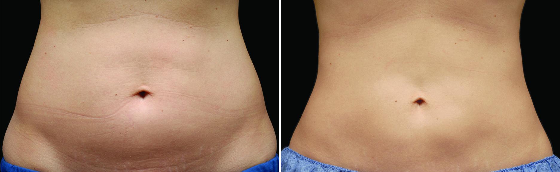 CoolSculpting Before & After Gallery - Patient 135525 - Image 1