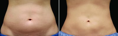 CoolSculpting Before & After Gallery - Patient 122405618 - Image 1