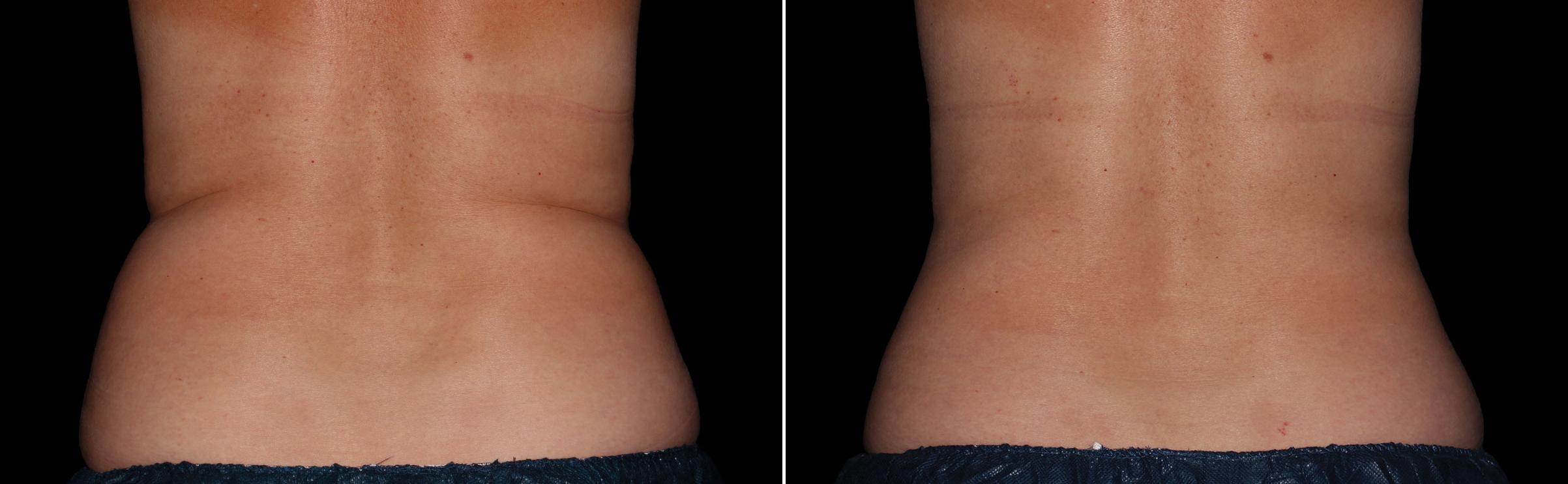 CoolSculpting Before & After Gallery - Patient 421668 - Image 1