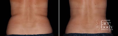 CoolSculpting Before & After Gallery - Patient 421668 - Image 1