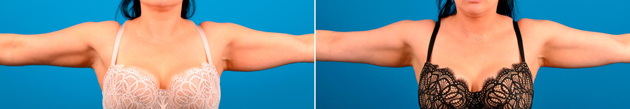 CoolSculpting Before & After Gallery - Patient 466453 - Image 1