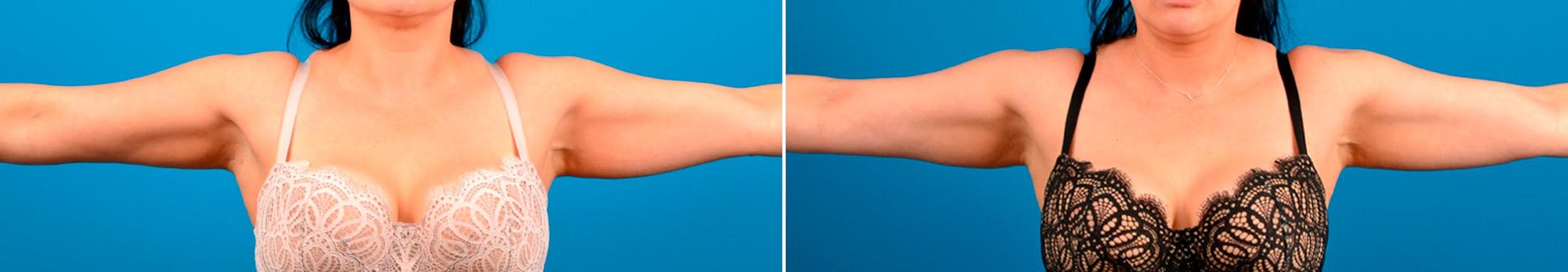 CoolSculpting Before & After Gallery - Patient 122405621 - Image 1