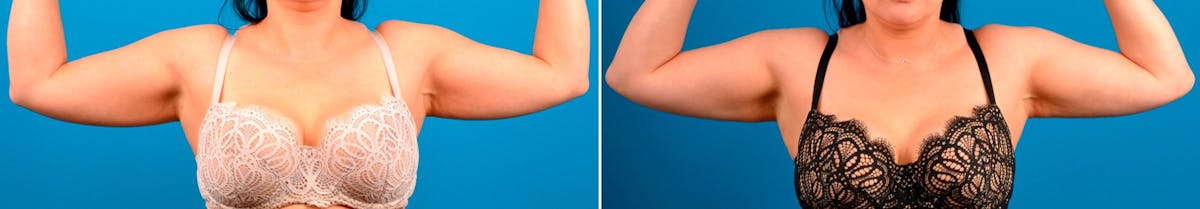 CoolSculpting Before & After Gallery - Patient 122405621 - Image 2