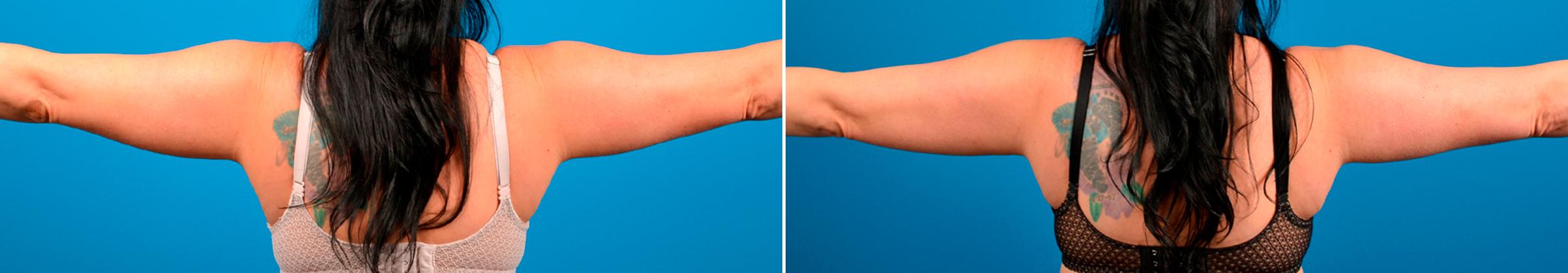 CoolSculpting Before & After Gallery - Patient 466453 - Image 3
