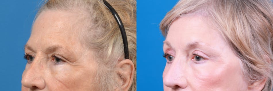 Brow Lift Before & After Gallery - Patient 122405622 - Image 1
