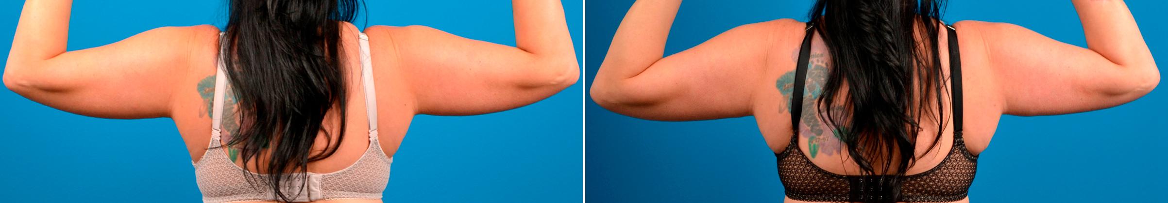 CoolSculpting Before & After Gallery - Patient 466453 - Image 4