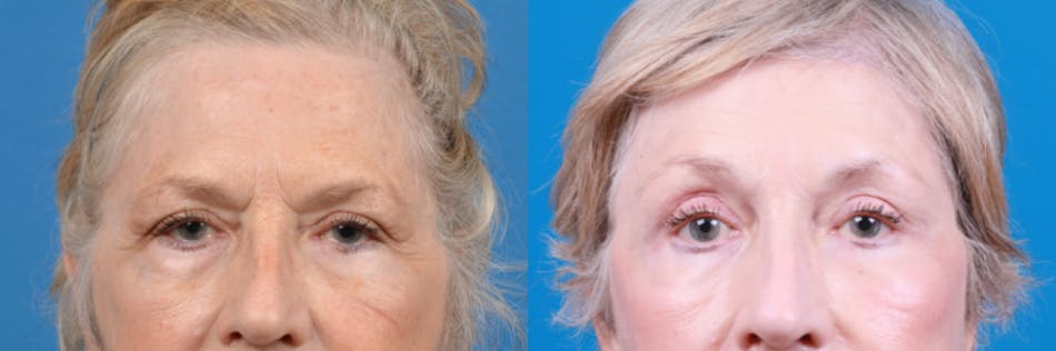 Brow Lift Before & After Gallery - Patient 122405622 - Image 2