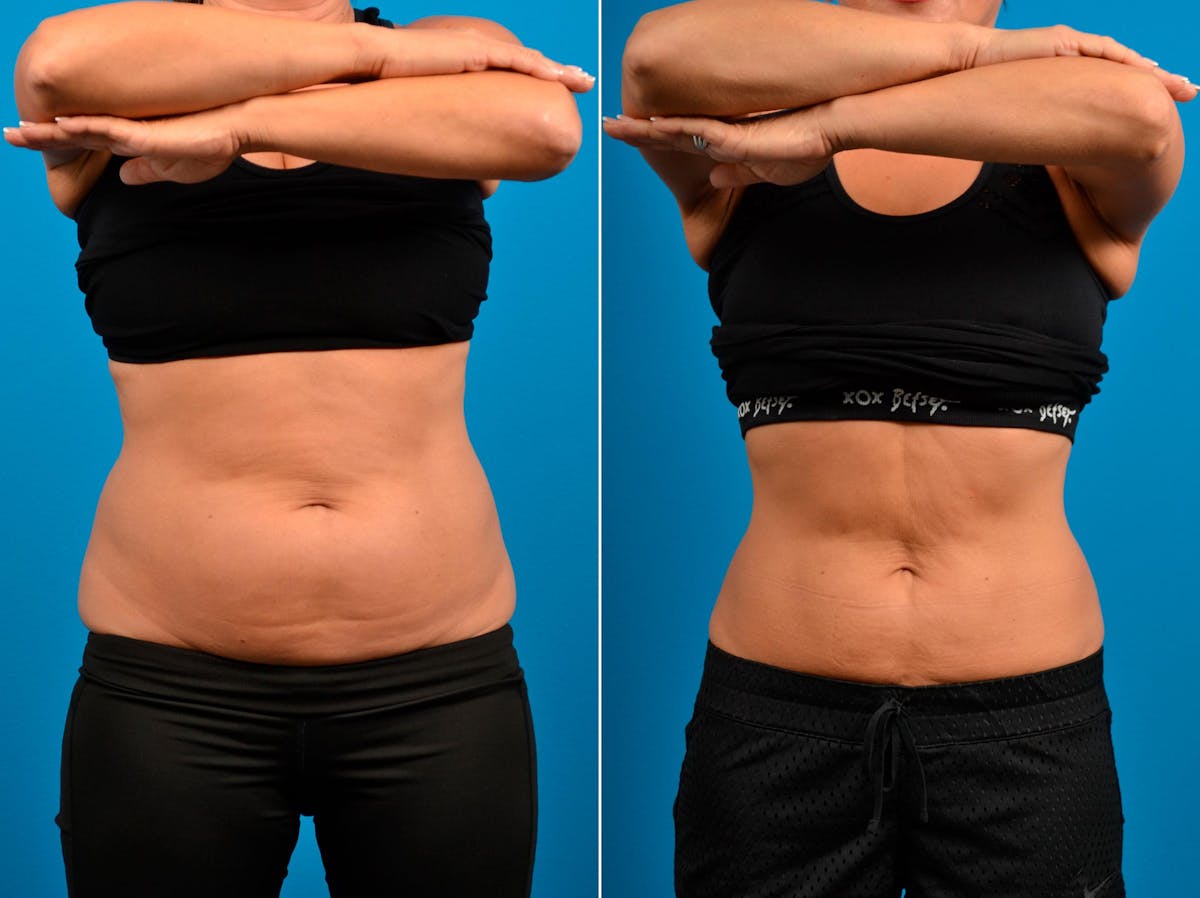 CoolSculpting Before & After Gallery - Patient 122405623 - Image 1