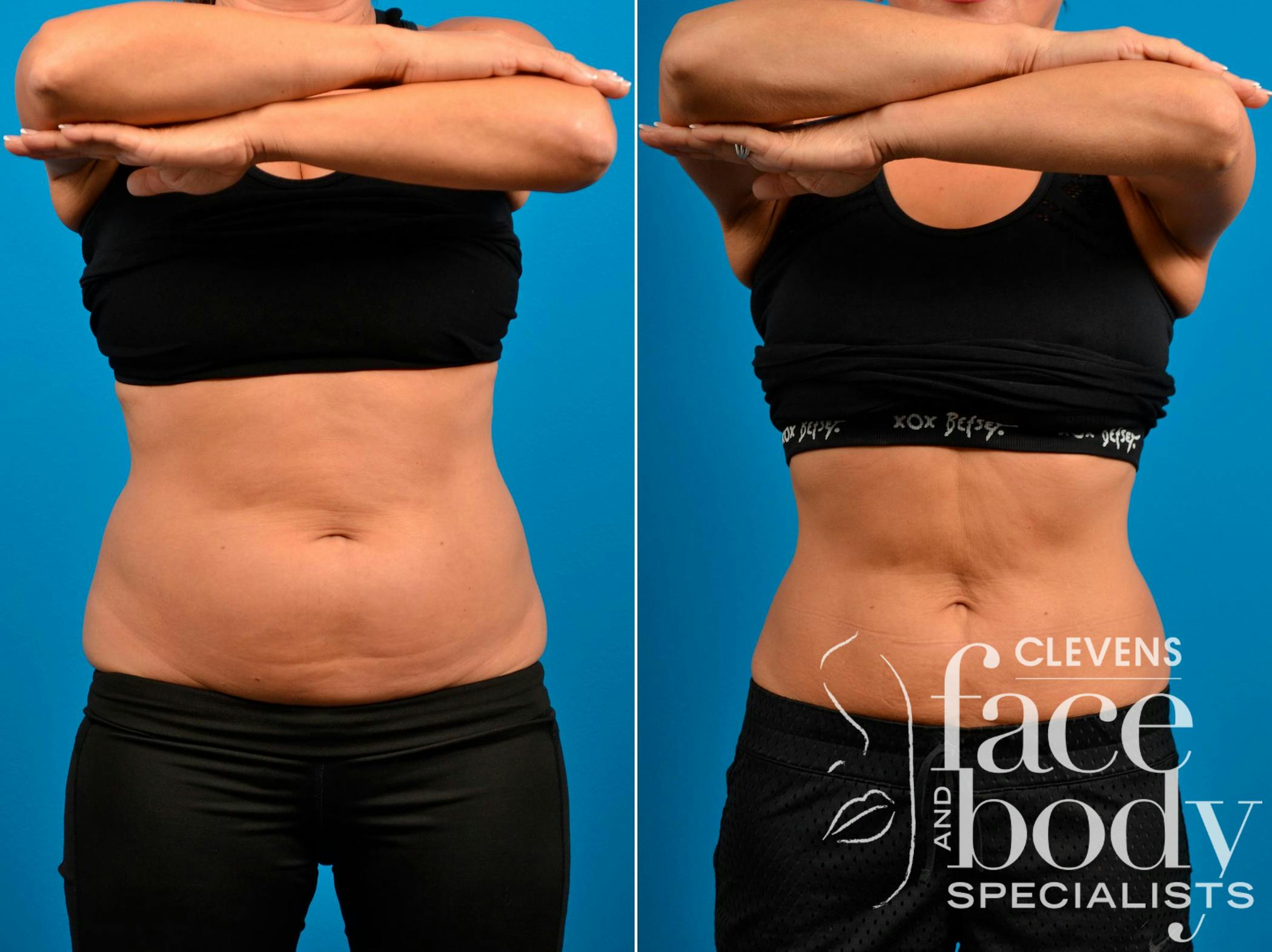 CoolSculpting ELITE
