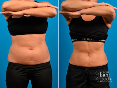 CoolSculpting Before & After Gallery - Patient 151870 - Image 1