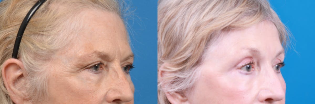 Brow Lift Before & After Gallery - Patient 122405622 - Image 3