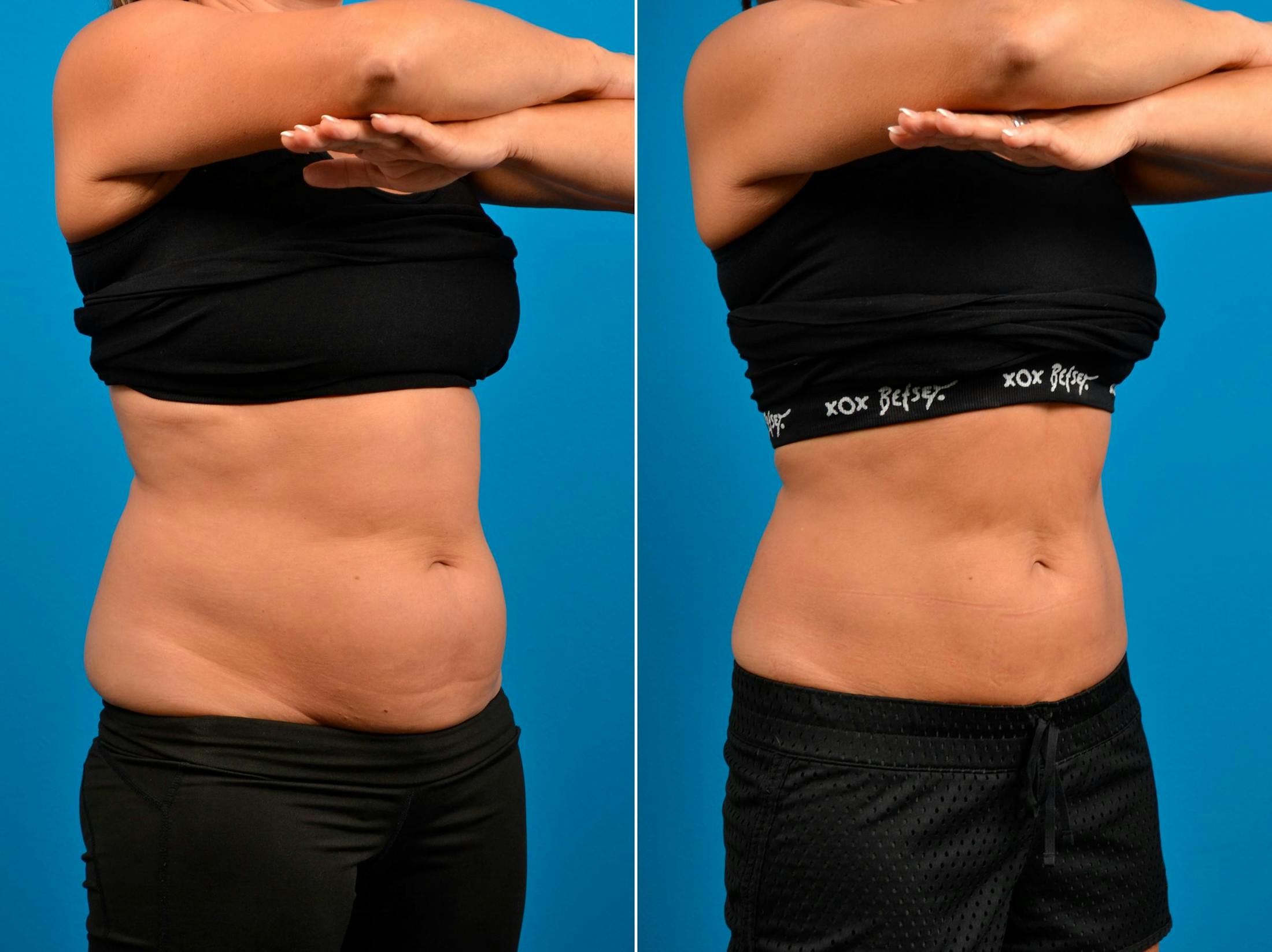 CoolSculpting Before & After Gallery - Patient 122405623 - Image 2