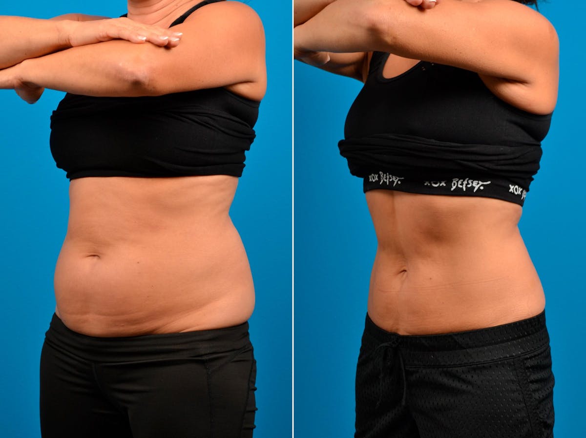 CoolSculpting Before & After Gallery - Patient 122405623 - Image 3