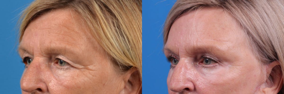 Brow Lift Before & After Gallery - Patient 122405624 - Image 1