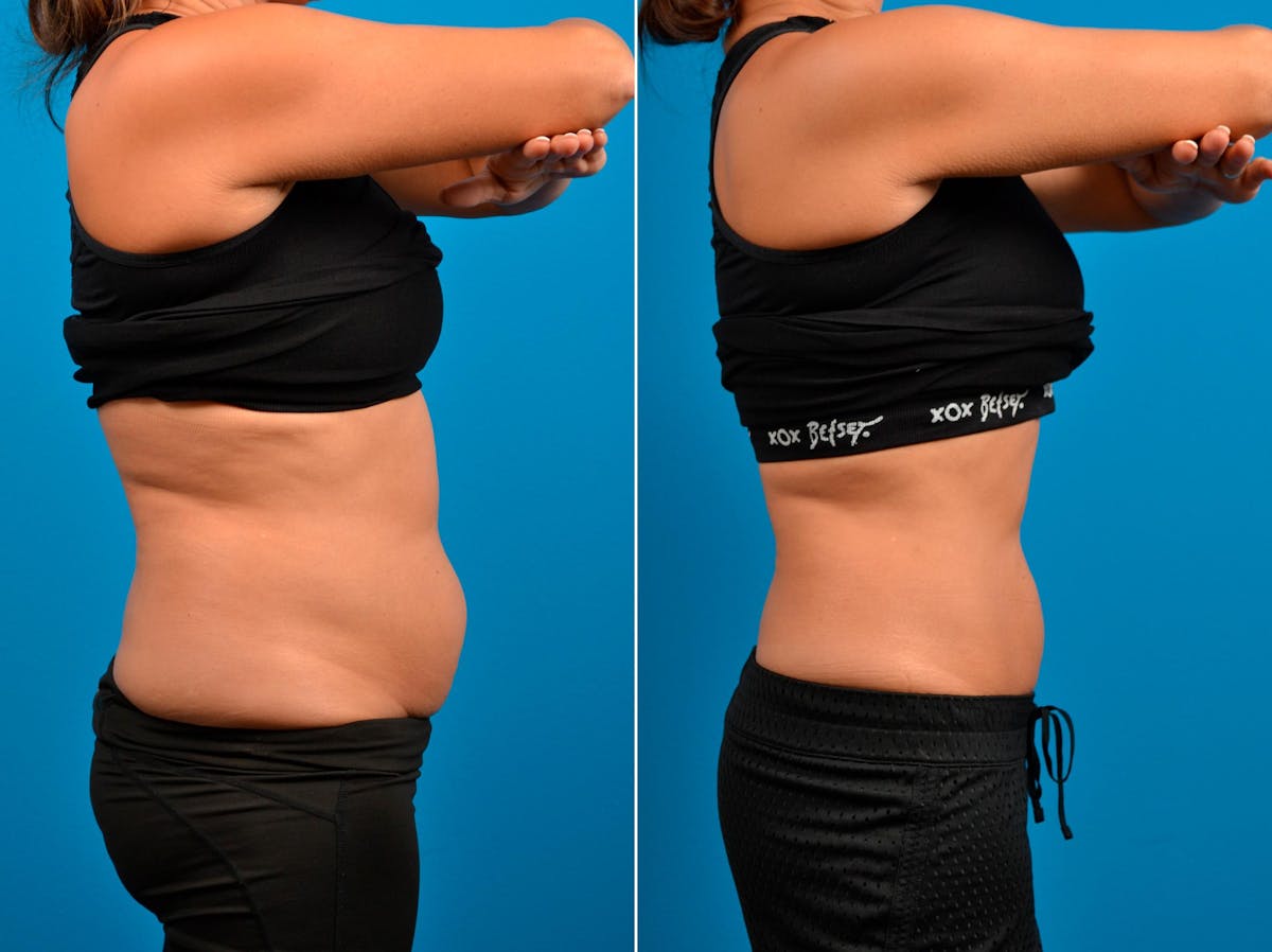 CoolSculpting Before & After Gallery - Patient 122405623 - Image 4